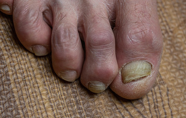 Curled toes on feet of Parkinson's Disease and fungi 