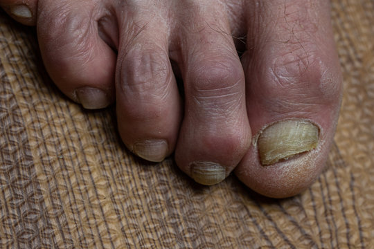 Curled toes on feet of Parkinson's Disease and fungi 