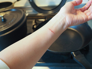 Close up of heat burn scar on woman's arm. Wounds caused by scald while cooking with heated pan at...