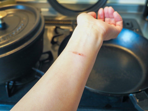 Close up of heat burn scar on woman's arm. Wounds caused by scald while cooking with heated pan at kitchen. Background with kitchen items.