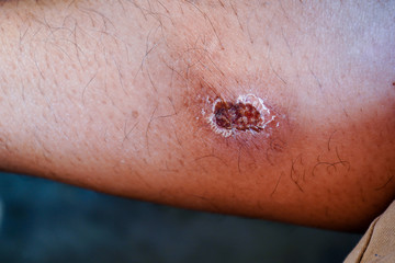 Wound scab injury on leg skin.