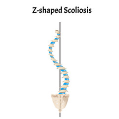 Z-shaped scoliosis. Dextroscoliosis. Levoscoliosis. Spinal curvature, kyphosis, lordosis, scoliosis, arthrosis. Infographics. Vector illustration on isolated background.