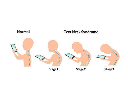 Improper posture symptoms. Stage Text Neck Syndrome. Spinal curvature, kyphosis, lordosis, scoliosis, arthrosis. Improper posture and stoop. Infographics. Vector illustration on isolated background.
