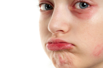 Naklejka premium Allergic reaction, skin rash, close view portrait of a girl's face. Redness and inflammation of the skin in the eyes and lips. Immune system disease.