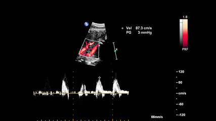 Ultrasound screen with fetal echocardiography.