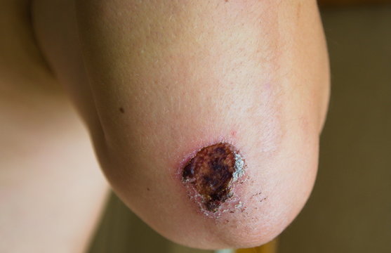 Strup po otarciu na łokciu.