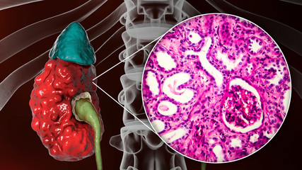 Chronic pyelonephritis, 3D illustration showing gross morphology with irregular scarred cortical surface and light micrograph showing interstitial fibrosis and inflammation