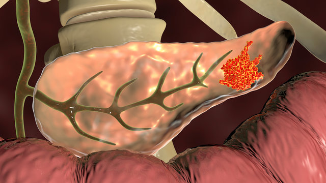 Pancreatic cancer, malignant tumor of pancreas, 3D illustration