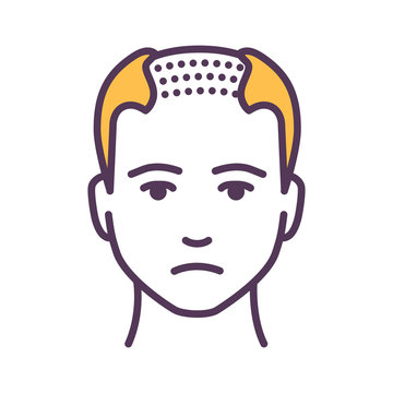 recommend clip art: Man with a bald head color line icon. Baldness stage. Alopecia. Pictogram for web page, mobile app, promo. UI UX GUI design element. Editable stroke.