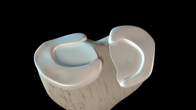 Meniscus Tear