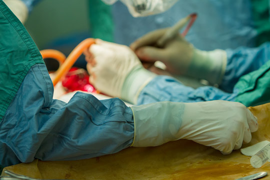  In the foreground is a close-up of the hands of an assistant surgeon, in the background is the hands of a surgeon during an operation.