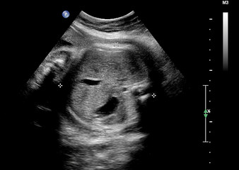 Ultrasound of fetus in third month pregnancy