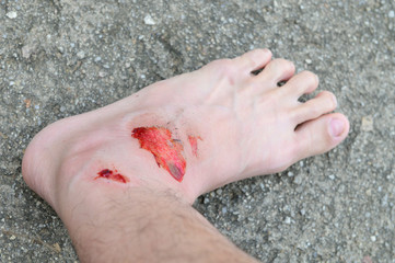 Closeup human foot with fresh wound abrasion from the accident