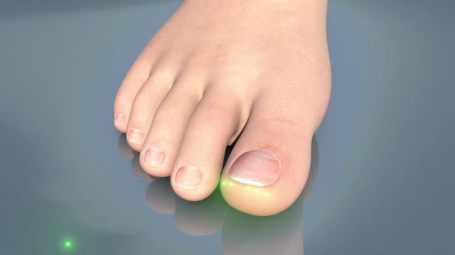 Onychomycosis of the Toenail