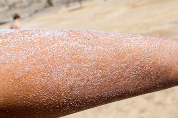 Arm covered by salt after bathing in the Dead Sea, Jordan - obrazy, fototapety, plakaty