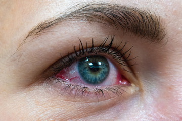 One female eye with red protein from allergic conjunctivitis