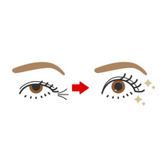 目尻のシワ　ビフォーアフター