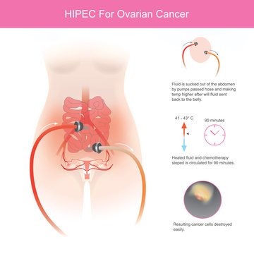 HIPEC For Ovarian Cancer. The Use Of Chemotherapy To Destroy Ovarian Cancer Cells Through Fluid In The Abdomen At Higher Temperatures To Allow The Drug To Touch Cancer Cells In The Treatment Easier.