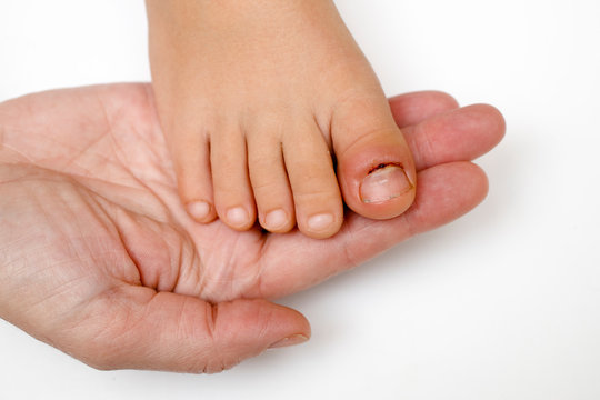 Onychie Bilder Durchsuchen 333 Archivfotos, und Videos