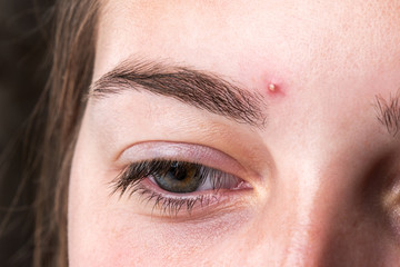 Fototapeta na wymiar Acne on female forehead. Problem skin.