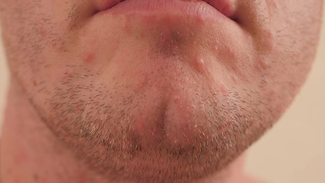Close-up face of an adult man with rashes and large blistering blisters on the skin, a man fell ill with chicken pox.