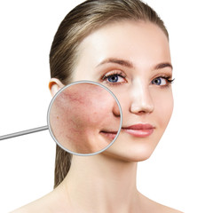 Magnifying glass shows facial skin before couperose treatment.