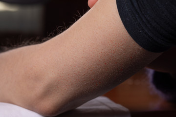 Female arm showing signs of keratosis pilaris in the form of reddish spots similar to the symptoms of acneiform rosacea