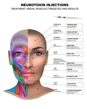 Neurotoxin injections treatment areas, muscles targeted and results. Muscles structure of the female face and neck, each muscle with name on it.