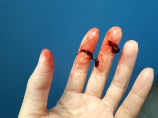 Hand stain Deep red blood clot in hand Symptoms of hemorrhage are life threatening When there is...
