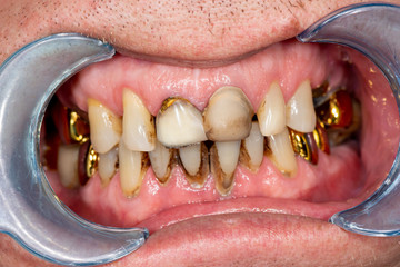 Obraz premium Plaque of the patient, stone. Dentistry treatment of dental plaque, professional oral hygiene. The concept of harm to smoking and cleaning teeth