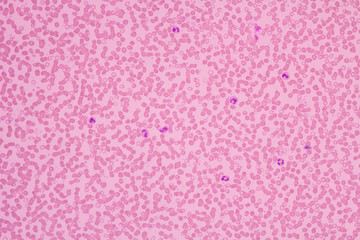Human blood smear view in microscopy.Complete blood count for treatment. Polymorphonuclear cells(PMNs), eosinophils and lymphocytes.Hematology laboratory.Medical background.Magnification 600 x.
