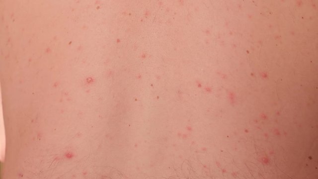 Close-up of chickenpox on the back of an adult male. Adult male with red rashes on the skin of the back, chicken pox disease.