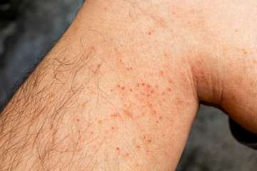 Skin disease winter. Healthcare dry cracking skin and rash red of leg on during weather cold. Dermatologist and treatment medication concept.