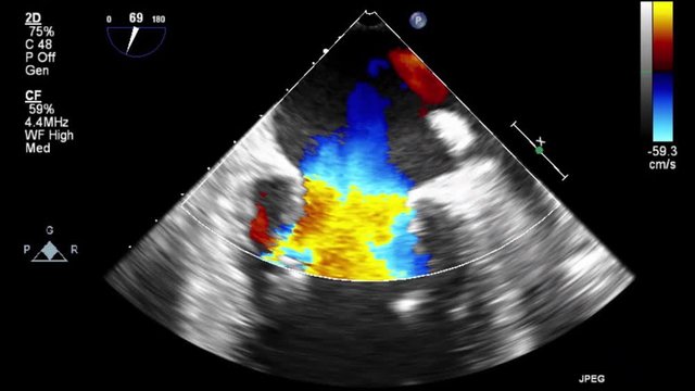 Transesophageal ultrasound video in Doppler mode.