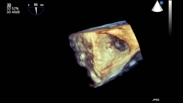 Transesophageal ultrasound video in 3D mode.