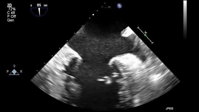 Transesophageal ultrasound video in gray-scale mode.