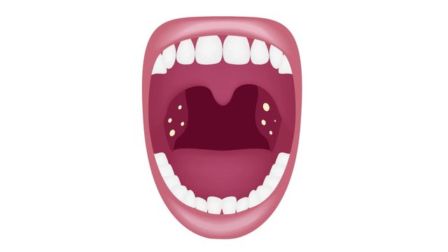 tonsil stone in the mouth graphic animation