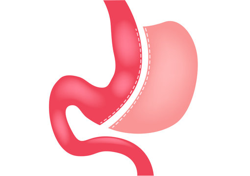 laparoscopic gastrectomy Gastric Sleeve / weight loss surgery vector
