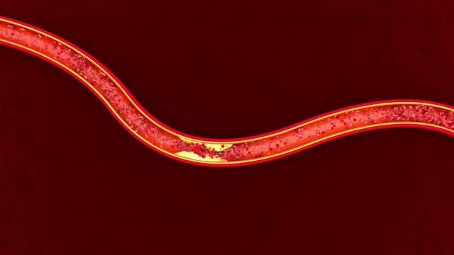 3D rendered Animation of Hemoglobin cells flowing through a clogged Artery developing the illness Arteriosclerosis.