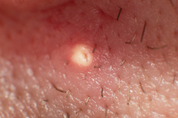 Fototapeta premium Acne pus, Close up photo of acne prone skin