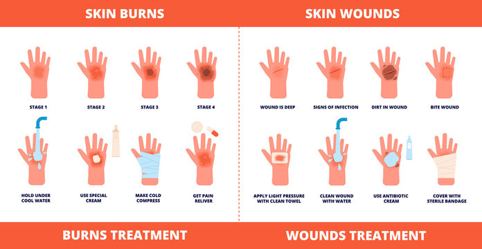 Skin first aid. Burns treatment, wounds and trauma symptoms. Degree burn, help hand healing with cream, bandaging and pills vector poster. Injury skin and wound care, treatment hurt illustration