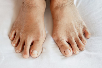 closeup woman feet suffering from joint pain with gout in finger