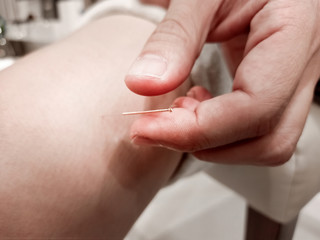 Doctor sticks needles into the body on acupuncture . Acupuncture needles showing acupuncture points on human body to heal and relax therapy. Body Acupuncture Science in Traditional Chinese Medicine.