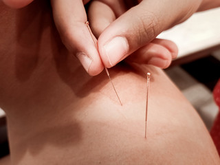 Doctor sticks needles into the body on acupuncture . Acupuncture needles showing acupuncture points on human body to heal and relax therapy. Body Acupuncture Science in Traditional Chinese Medicine.