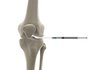 3d rendered medically accurate illustration of a knee joint injection