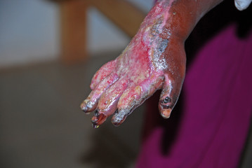 The serious burns to a hand of a child African-Tanzania-Africa