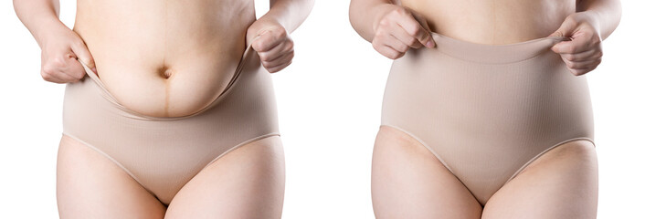 Woman's body before and after weight loss, flabby belly after pregnancy, fat woman in corrective panties isolated on white background - obrazy, fototapety, plakaty