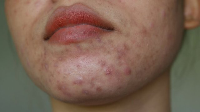 Close up skin problem and acne on Chin and face of women. 