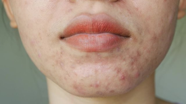 Women using equipment acne extractor pressing squeeze pimples on chin and face