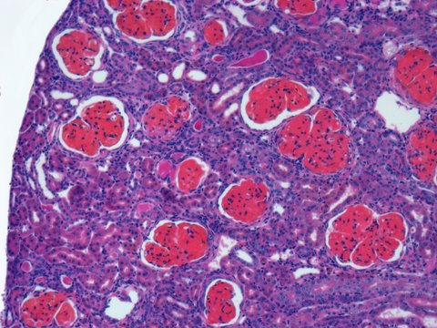 Glomerulonephritis, light micrograph